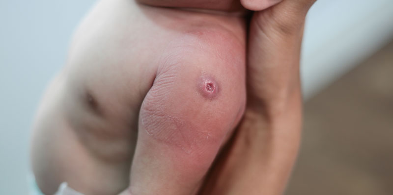 Alergiile-la-bebelusi